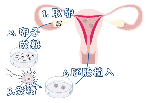 单身生育力保存